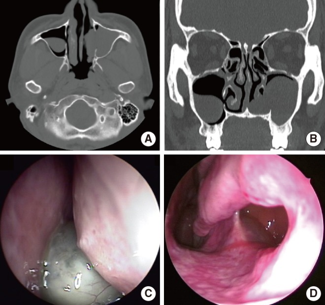 sinus cysts and polyps
